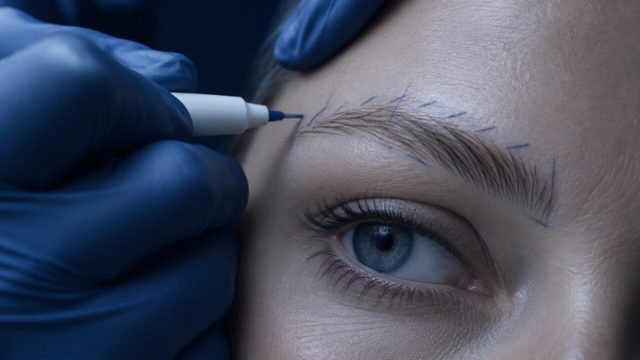 Eyebrow Transplant: Creating Natural Direction and Density