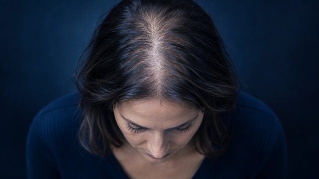 Female Pattern Hair Loss: Is a Transplant an Option?