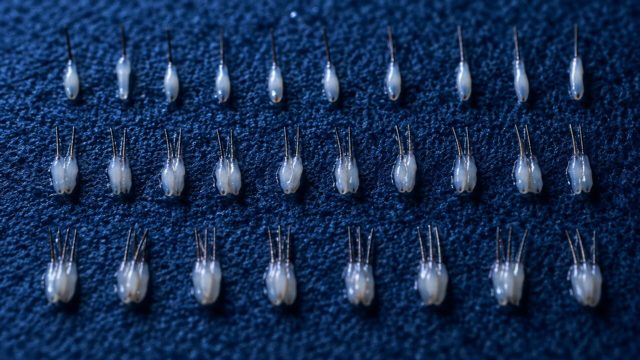 Transplantation d’unités folliculaires : planifier une densité naturelle