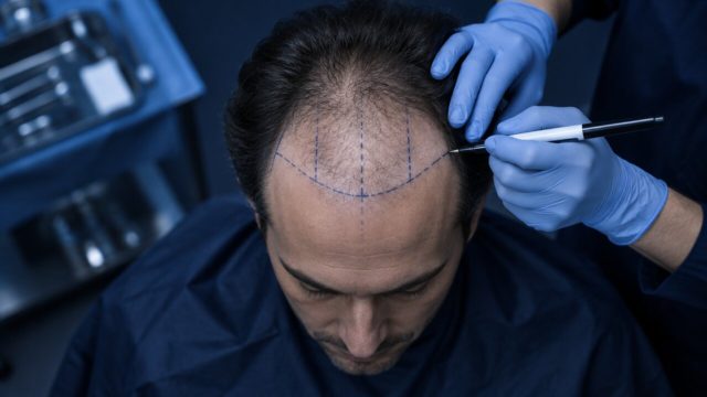 Hair Graft Turkey: How Graft Numbers Are Planned