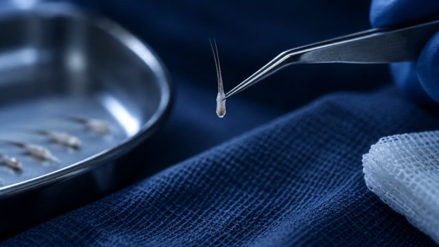 Hair Plugs for Men: How Modern Transplants Differ