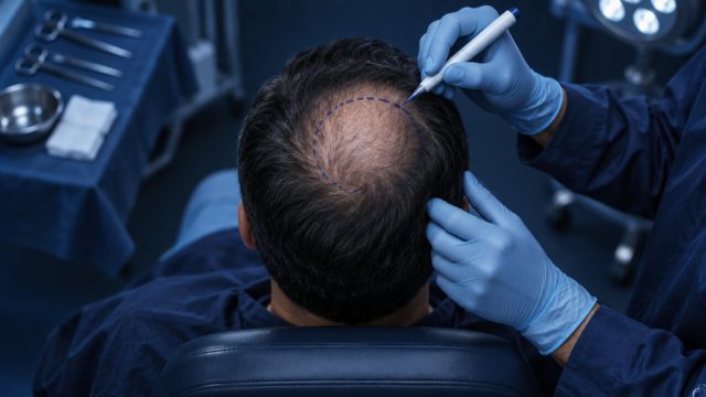 Hair Transplant in Winter: Travel, Healing, and Sun Protection