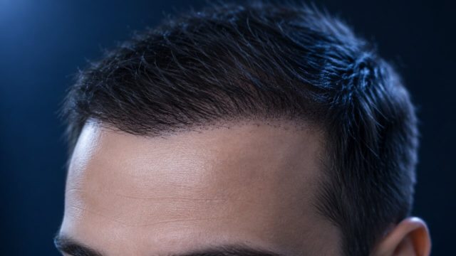 Phasen nach einer Haartransplantation: Von der Heilung bis zum neuen Wachstum