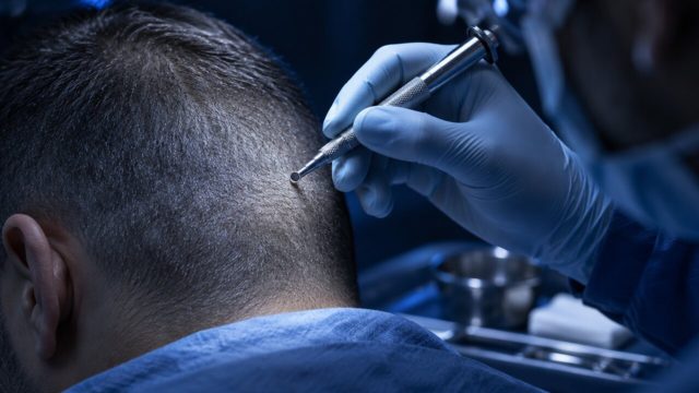 What Is FUE Hair Transplantation? A Patient Guide