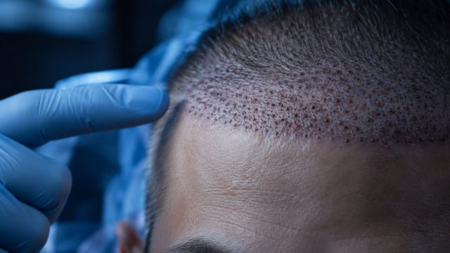 Why Transplanted Hairs Shed After Surgery