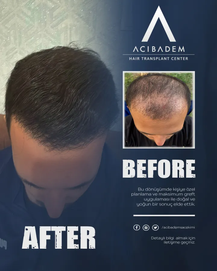 Hair transplant before and after — result 1