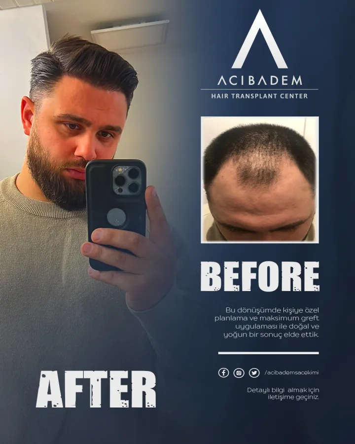 Hair transplant before and after — result 2