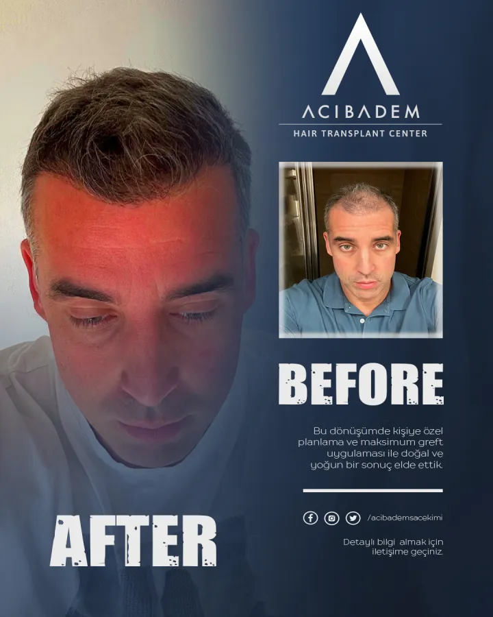 Hair transplant before and after — result 11