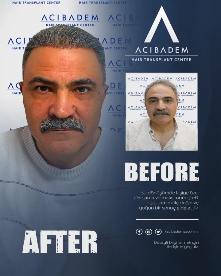 Hair transplant before and after — result 12