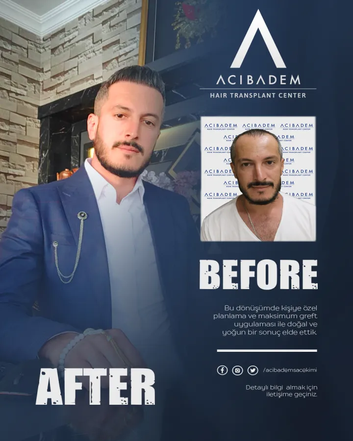 Hair transplant before and after — result 13