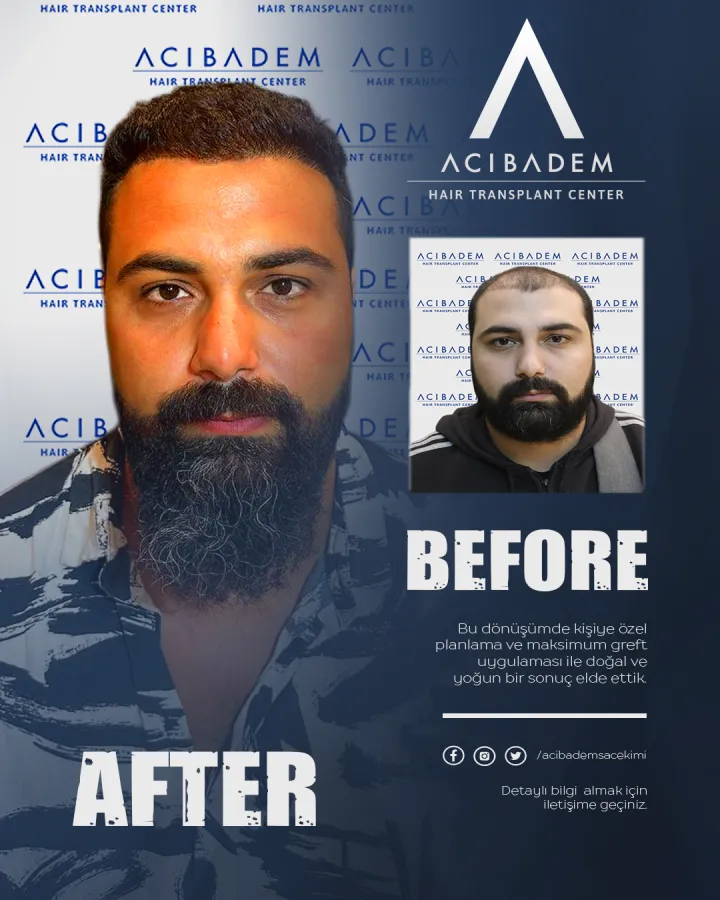 Hair transplant before and after — result 14