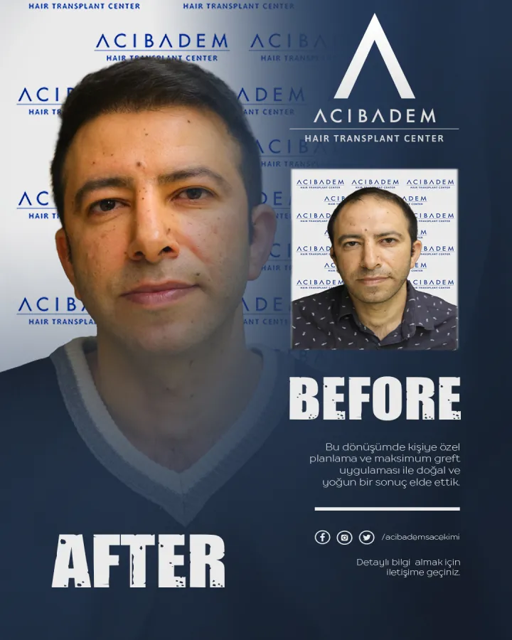 Hair transplant before and after — result 15