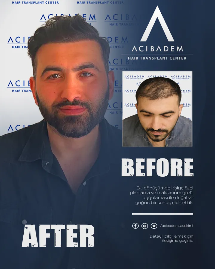 Hair transplant before and after — result 16