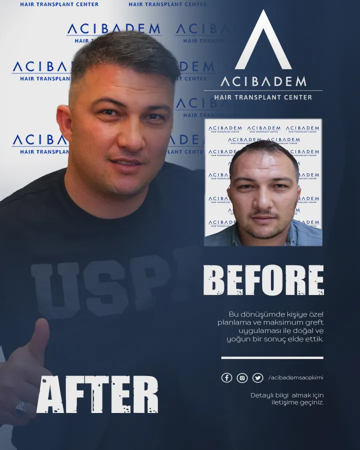 Hair transplant before and after — result 17