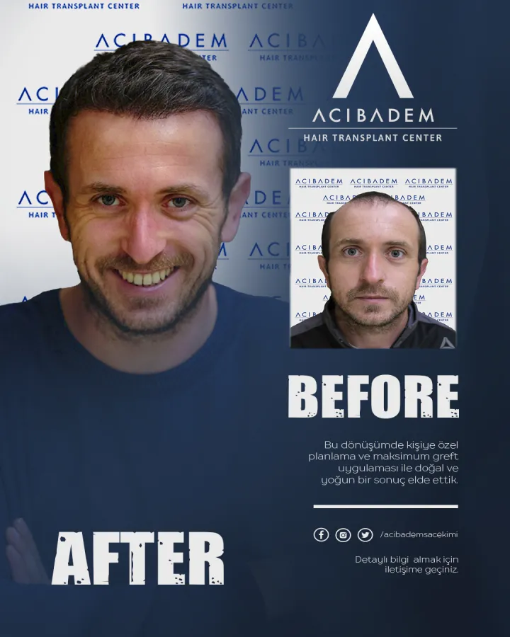 Hair transplant before and after — result 18
