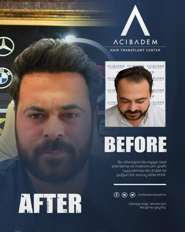 Hair transplant before and after — result 19