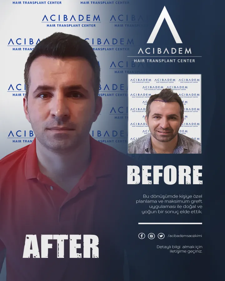 Hair transplant before and after — result 20