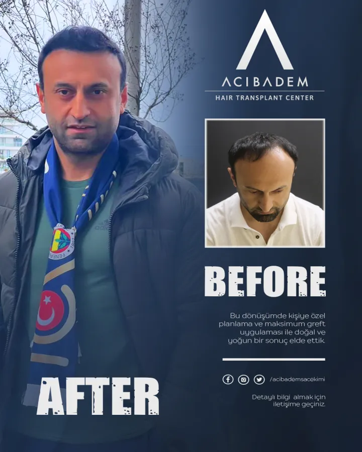 Hair transplant before and after — result 3