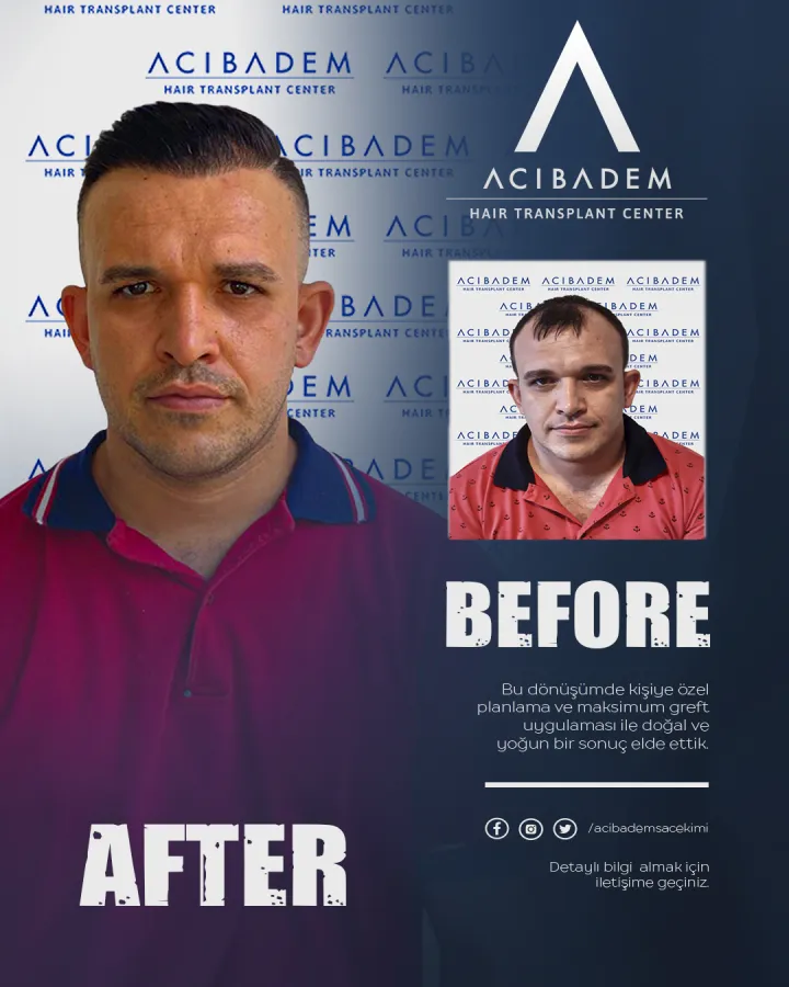 Hair transplant before and after — result 21