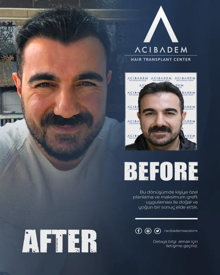 Hair transplant before and after — result 22