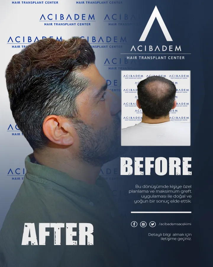 Hair transplant before and after — result 23