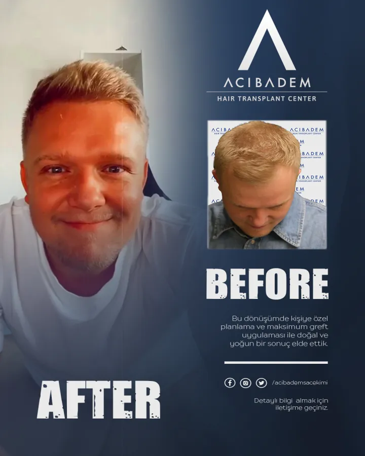 Hair transplant before and after — result 24