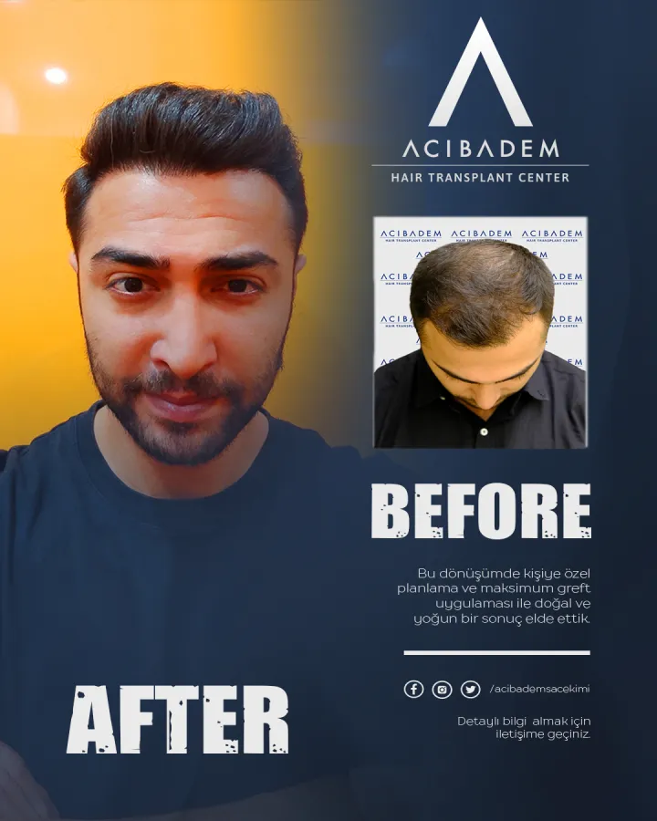 Hair transplant before and after — result 25