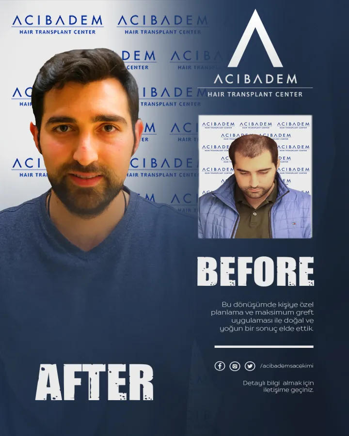 Hair transplant before and after — result 26