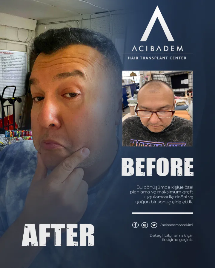 Hair transplant before and after — result 27