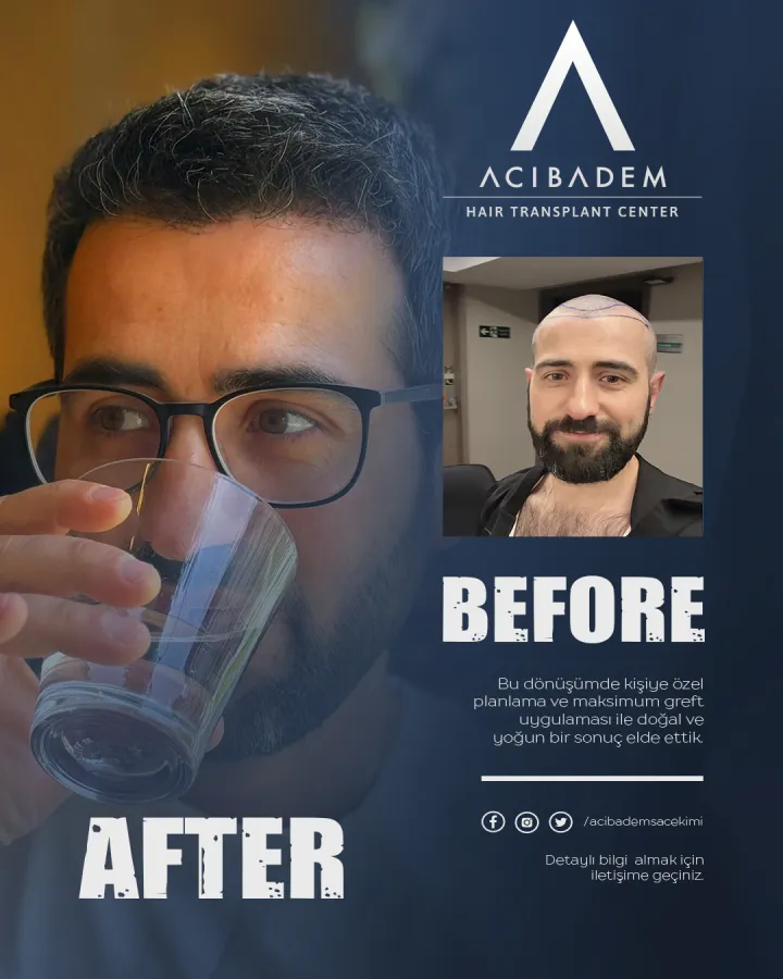 Hair transplant before and after — result 28