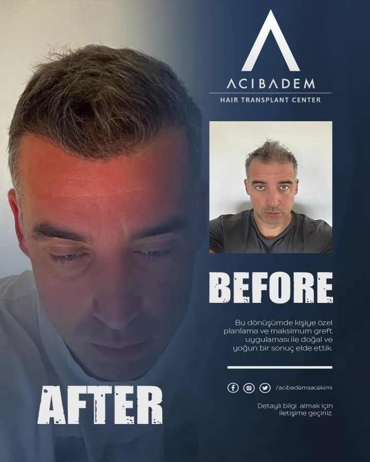 Hair transplant before and after — result 29