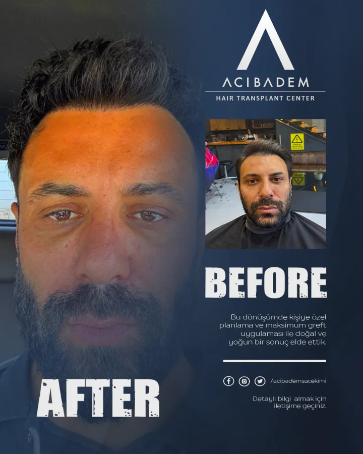 Hair transplant before and after — result 30