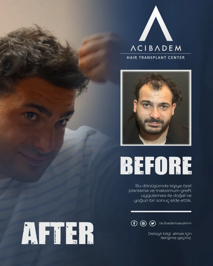 Hair transplant before and after — result 4