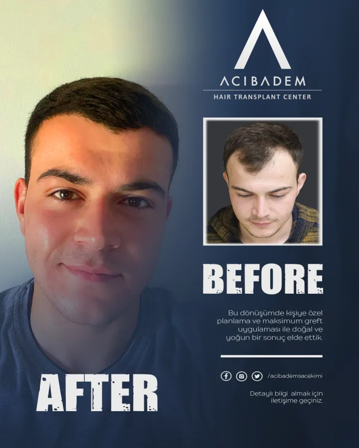 Hair transplant before and after — result 5