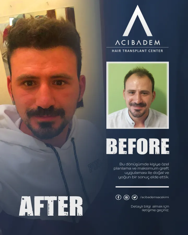 Hair transplant before and after — result 6
