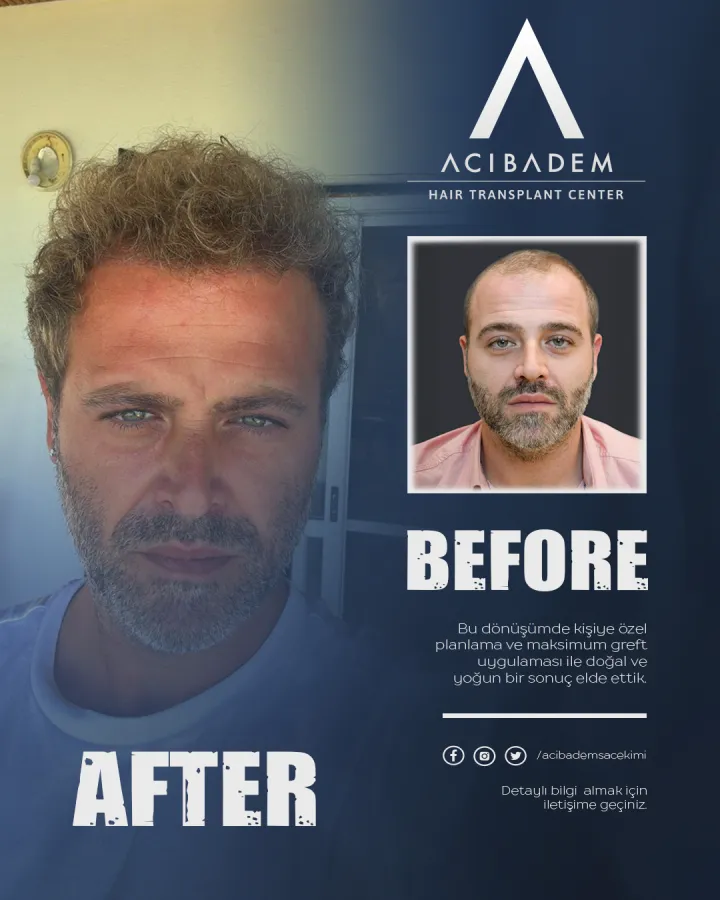 Hair transplant before and after — result 7