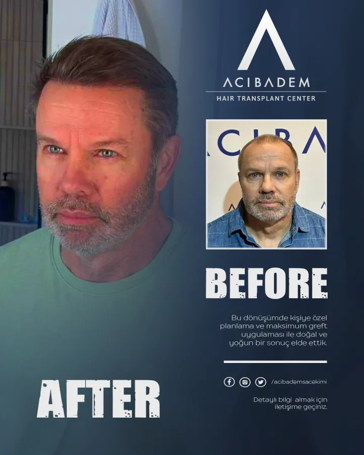 Hair transplant before and after — result 8