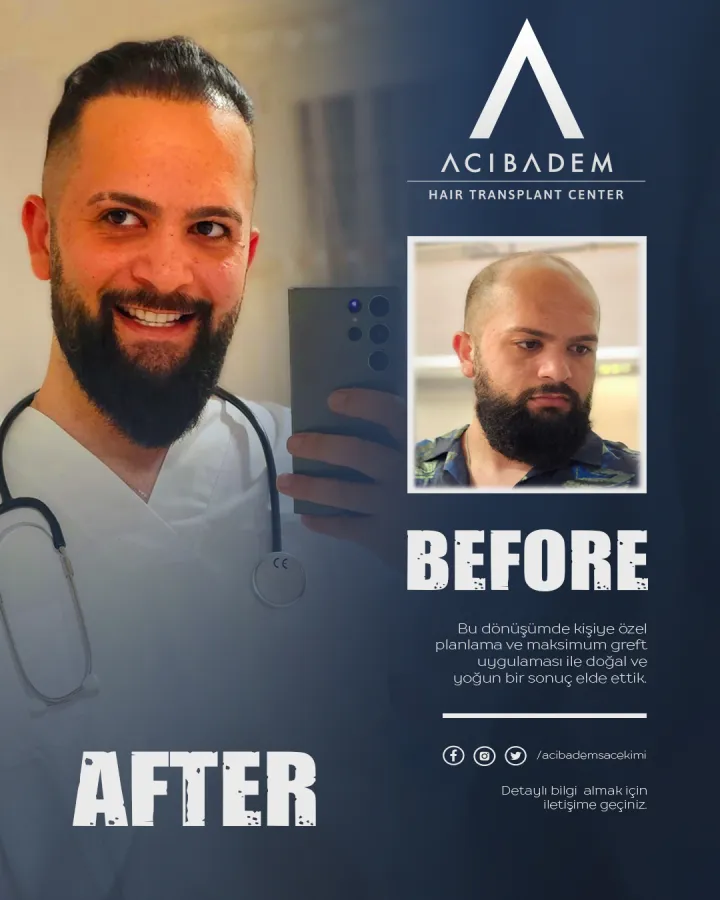 Hair transplant before and after — result 9