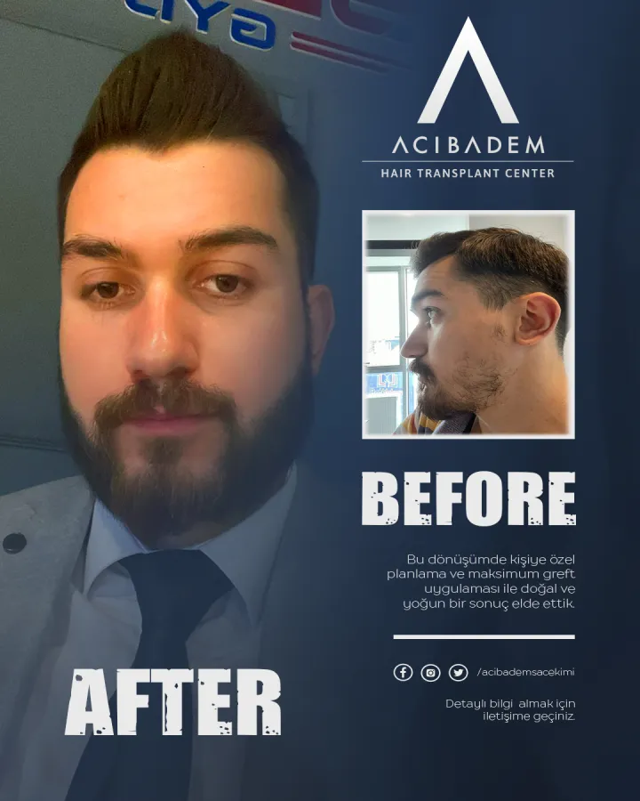 Hair transplant before and after — result 10